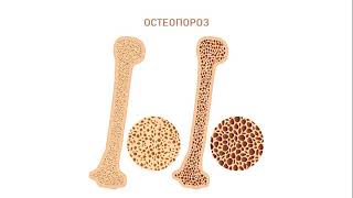 Osteoporoz nədir?