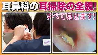 耳鼻科での耳掃除は手軽にできます!!!