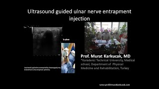 Ultrasound guided ulnar nerve entrapment injection, by Prof Murat Karkucak MD