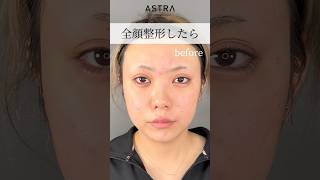 全顔整形したら、、🫢💖#astrabeautyclinic  #アストラビューティークリニック #塩満恵子 #鼻整形 #美容整形 #忘れ鼻