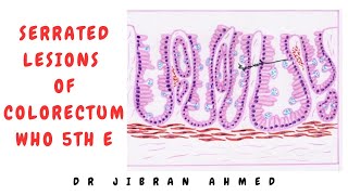 SERRATED LESIONS II COLORECTUM II GIT II WHO UPDATES