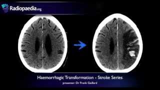Stroke: Haemorrhagic transformation - radiology video tutorial (CT, MRI)