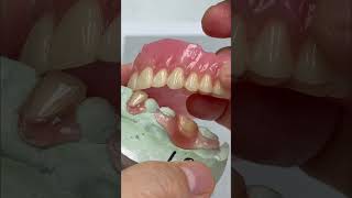 Flexible partial and denture for one patient!