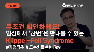 Klippel - Feil Syndrome 알고 치료하지 마세요~! | 메드쉐어 | 도수치료 | 금기 사항 | 강준한