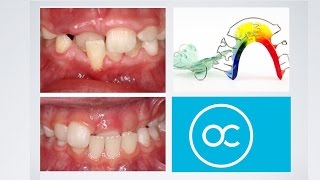 Interceptive Orthodontics At The Orthodontic Centre, Palmerston North