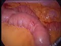 laparoscopic d2 lymph node dissection with total gastrectomy and jejunal pouch reconstruction for ea