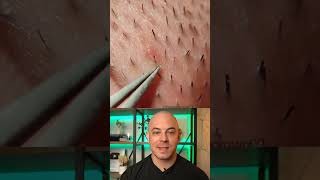 Derm reacts to infected ingrown hair removal! #dermreacts #doctorreacts #ingrownhairremoval
