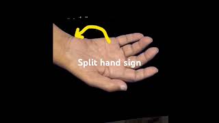 Split hand sign and Fasciculation: A clinical clue for ALS ( Amytrophic lateral sclerosis)