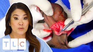 Dr. Lee Slices Away An Uncomfortable Sagging Keloid l Dr. Pimple Popper: This Is Zit l UNCENSORED