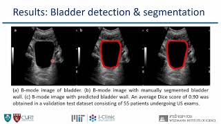 Jameel Clinic PI ’20: Deep Learning for Home-based Ultrasonic Screening of Pelvic Organs