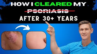 Psoriasis Treatment Answers- What I Ate, Supplements, and Lifestyle