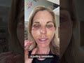 My Advanced Facelift Recovery Day by Day - Real Stories By Real Patients 2022