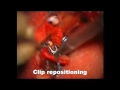 clipping of mca aneurysm how we do it in geneva 2011