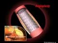 Angioplasty - Patient Education