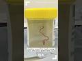 Australian surgeon removes ‘happily-moving’ alive worm from patient’s brain