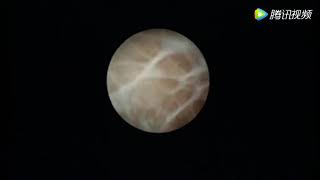 精囊鏡 Seminal Vesiculoscopy