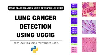 Lung Cancer Detection using VGG16 | Image Classification using Transfer Learning