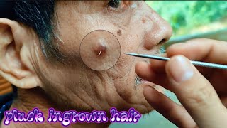 pluck ingrown facial hair, nhổ lông mọc ngược trên mặt cho chú Nghẽo asmr