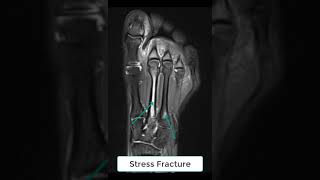 Stress Fracture