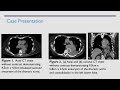 a rare presentation of streptococcus anginosus mycotic aortic aneurysm