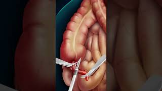 عملية استئصال الزائد الدودية Appendectomy #Appendectomy #جراحة_الكولون #عمليات_جراحية #طبيب #جراحة