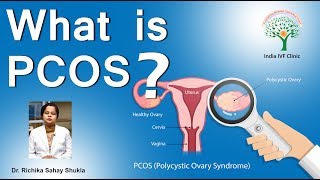 What is PCOS? Dr. Richika Sahay Shukla