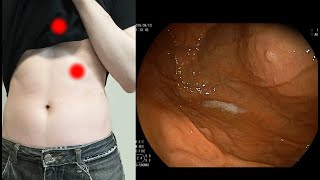 [胃カメラ]食道からの心臓の鼓動の様子 　The beating of the heart through the esophagus #endoscopy