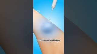 How Ganglion Cyst Removal Surgery Works #shorts #viralvideo - Creativelearning3d