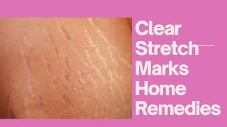 5 Ways To Remove Stretch Marks Home  Remedies #shorts
