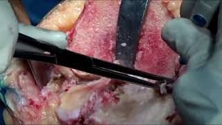 Primary Total Knee replacement in Severe Knee Osteoarthritis Surgical Technique : Dr Parag Sancheti