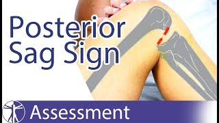 Posterior Sag Sign | Posterior Cruciate Ligament Tear