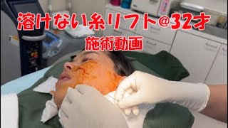 32才の女性に溶けない糸リフトしました②施術動画（鶴舞公園クリニック）