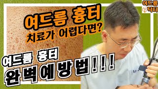 여드름 흉터 완벽 예방법!!! 여드름 나더라도 이렇게 하면 여드름 흉터가 남지 않습니다.  여드름 흉터  치료가 어렵다면 예방이 더욱 중요하겠죠? 쉽게 따라하는 여드름 흉터 예방법