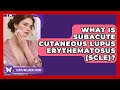 What Is Subacute Cutaneous Lupus Erythematosus (SCLE)? - Lupus Wellness Guide