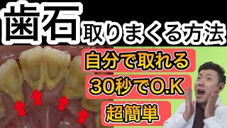 ３０秒！自分で歯石を取る方法！歯周病や虫歯、歯槽膿漏の原因になります。【歯石】【歯周病】