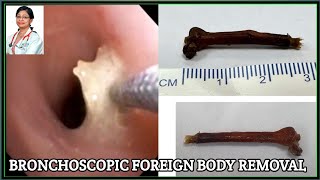 Emergency Pediatric Foreign Body Removal #BD_ENDOSCOPY