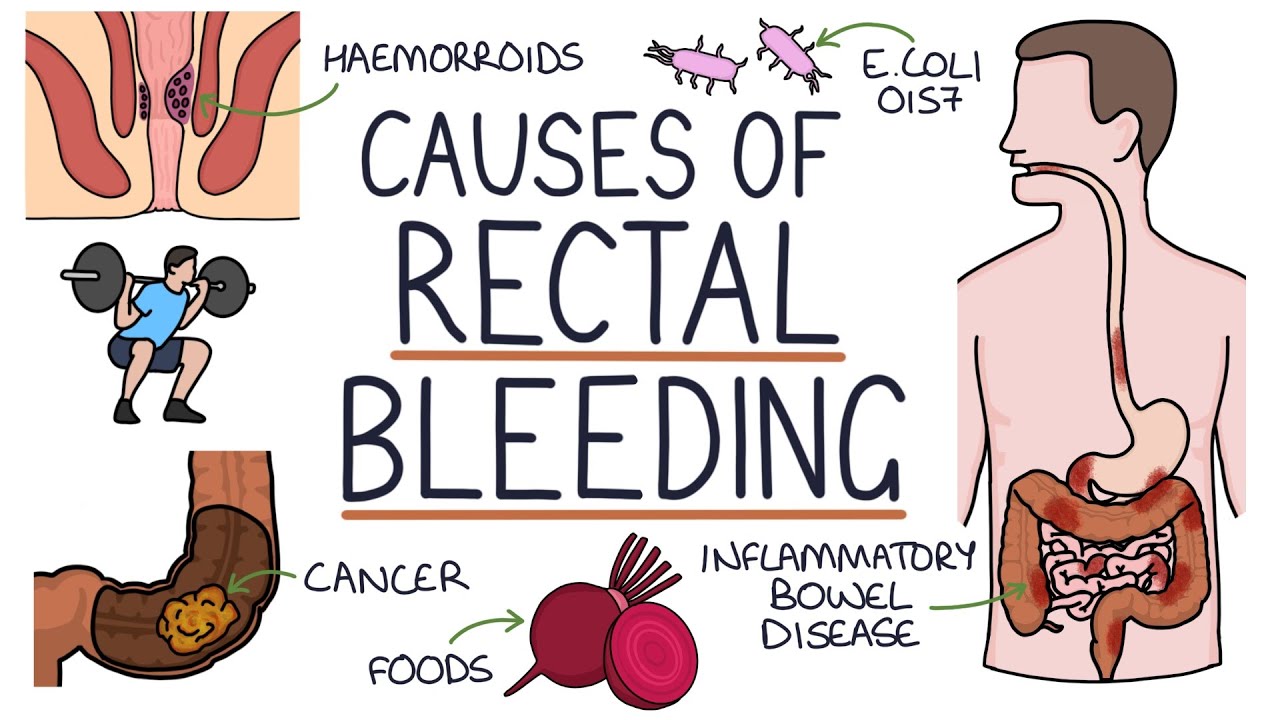 Understanding The Causes Of Blood In Stool (Rectal Bleeding) - YouTube