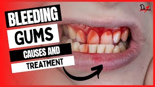 Bleeding Gums Causes \u0026 Treatment