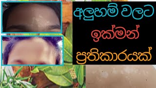 අලුහම් නැතිකර ගැනීමට මේ බෙහෙත් වට්ටෝරුව භාවිතා කර බලන්න.