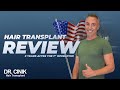 Review 3 Years After The Operation | Dr.Cinik Hair Transplant | FUE |  Hair Growth Results