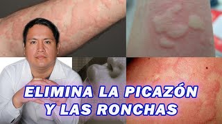 Todo lo que debes saber sobre el tratamiento de la urticaria