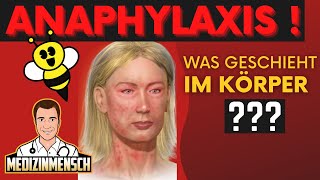 ANAPHYLAKTISCHER SCHOCK: Was Passiert Im Körper ? (Arzt erklärt)