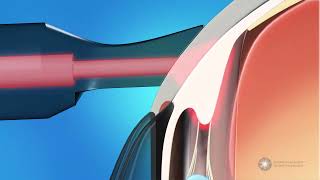 Micropulse Cyclophotocoagulation