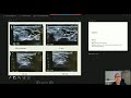 Case share by Prof Bulent Cekic on CCMA Online Classroom Series - Head & Neck Tumor Session