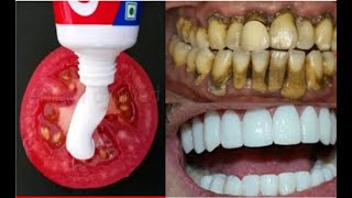 Teeth whitening at home in 3 minutes|| How to whiten your yellow teeth naturally|| 100% effective