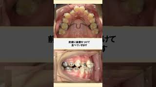 八重歯の矯正歯科治療 #矯正歯科 #美容# #braces