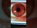 Severe contact lens-related infectious keratitis scar Kanellopoulos MD