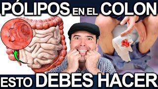 COMO ELIMINAR LOS PÓLIPOS DEL COLON 100% EFECTIVO