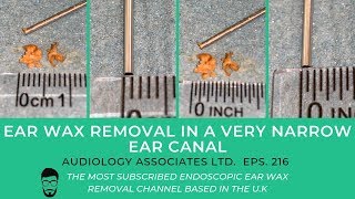 EAR WAX REMOVAL IN A VERY NARROW EAR CANAL - EP 216