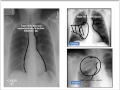 Structured Interpretation of Chest Xray